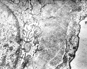 F,26y. | membranous glomerulopathy